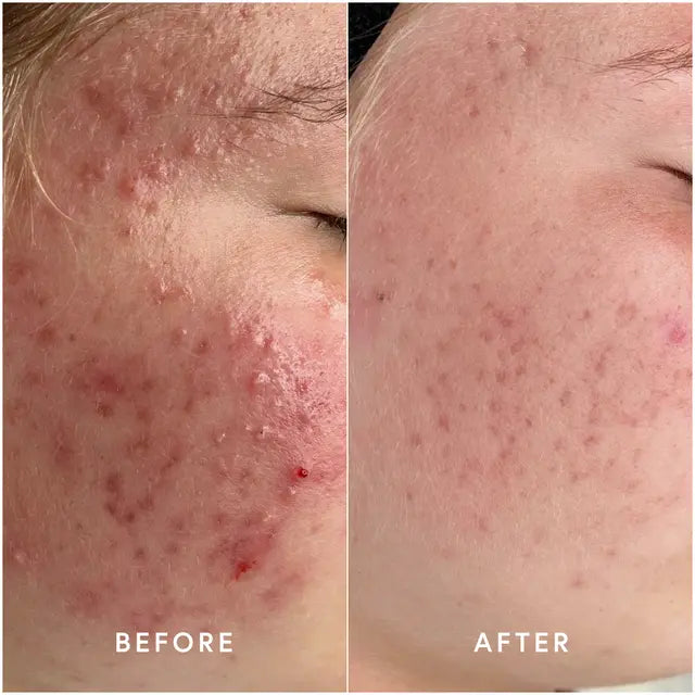 InvisiClear Hydrocolloid Spot Patches