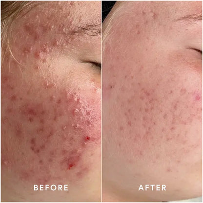 InvisiClear Hydrocolloid Spot Patches